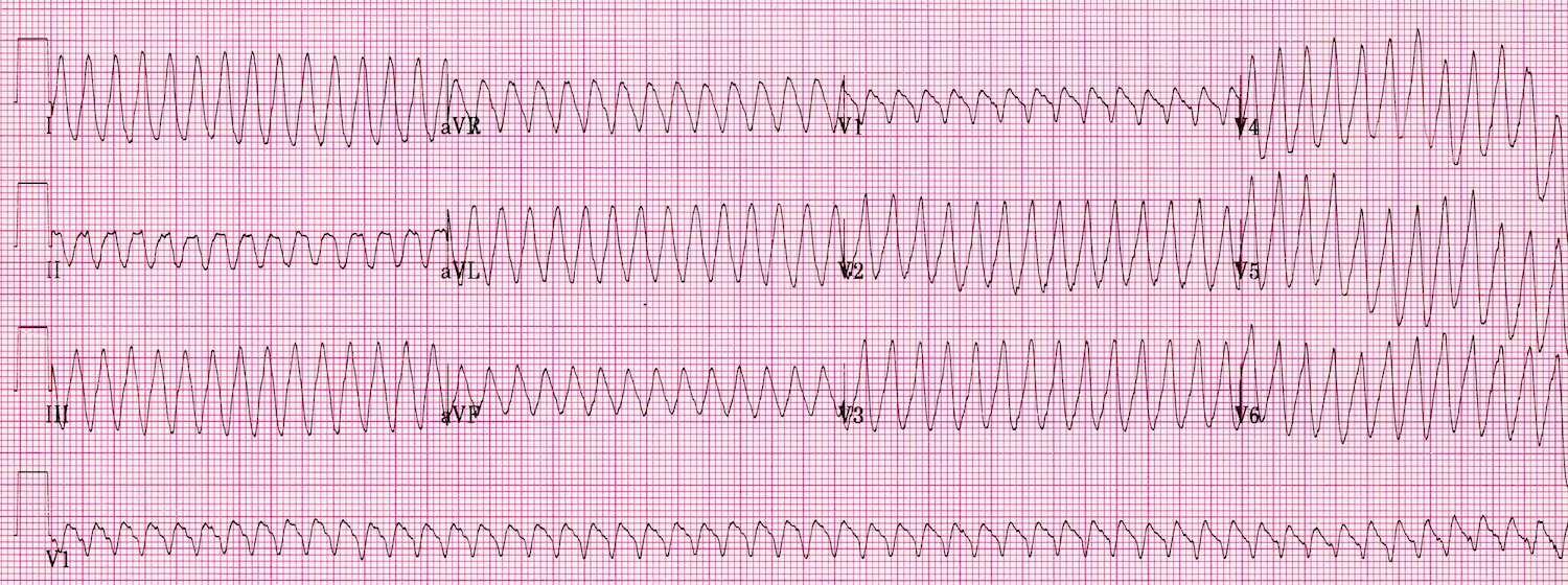 Kaynak : lifeinthefastlane.com - ECG library