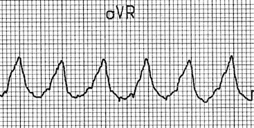 aVR'de dominant R dalga başlangıcı -> VT Kaynak : lifeinthefastlane.com - ECG library