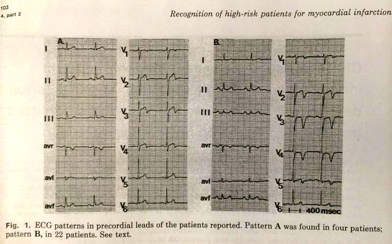 Wellens Sendromu 5 de Zwaan C, Bär FW, Wellens HJ orjinal sayfasından Wellens EKG patternleri sınıflandırması. Miyokard infarktı tehditi nedeniyle hastaneye yatırılmış hastalarda sol ön inen arterde kritik darlığa işaret eden karakteristik elektrokardiyografik pattern . Am Heart J. 1982 Apr;103(4 Pt 2):730-6.