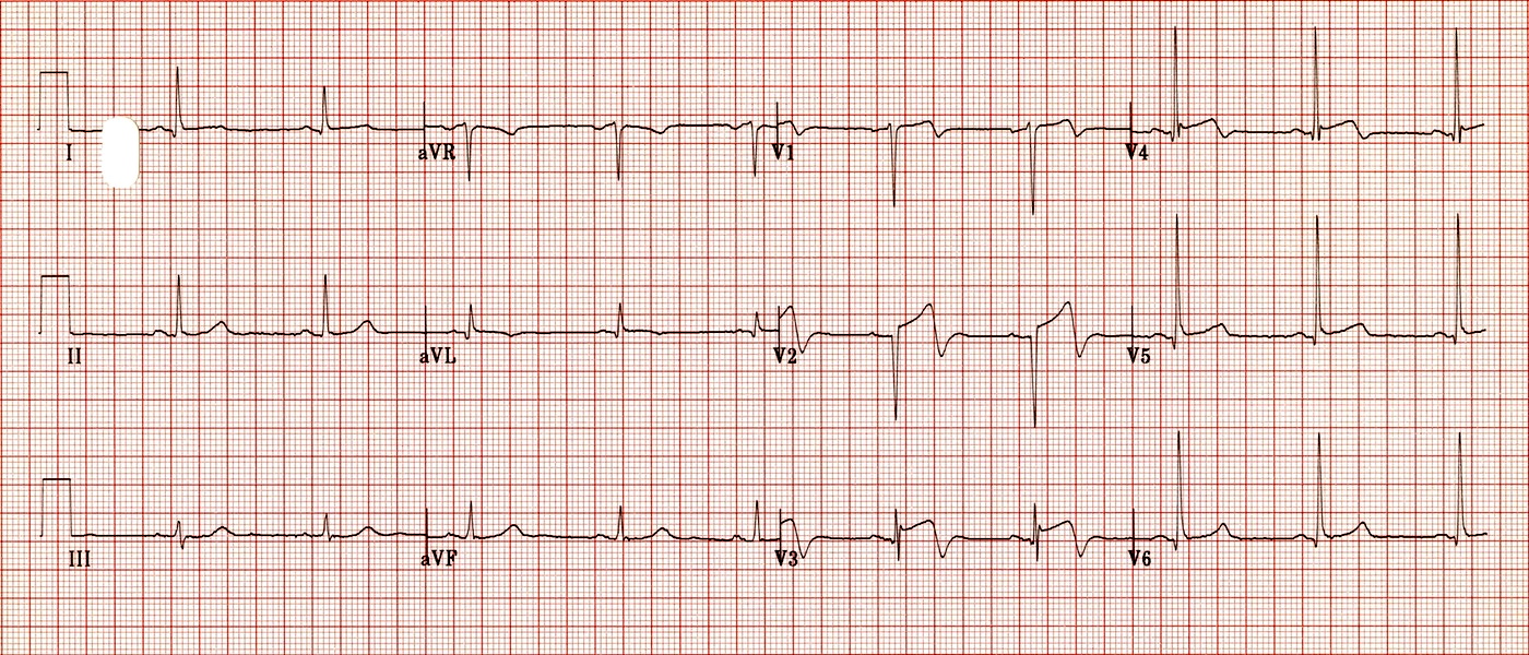Wellens Sendromu 6 Kaynak : lifeinthefastlane.com - ECG library