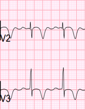 Wellens Sendromu 3 Kaynak : lifeinthefastlane.com - ECG library