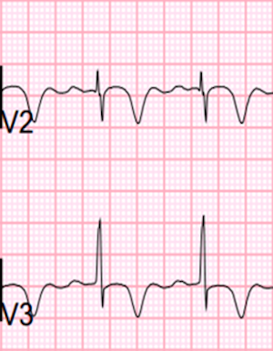 Kaynak : lifeinthefastlane.com - ECG library