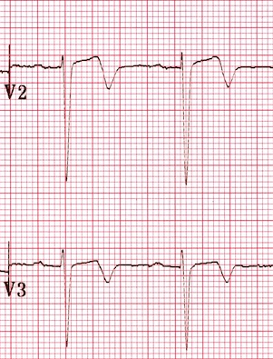 Wellens Sendromu 2 wellens-patterns-A