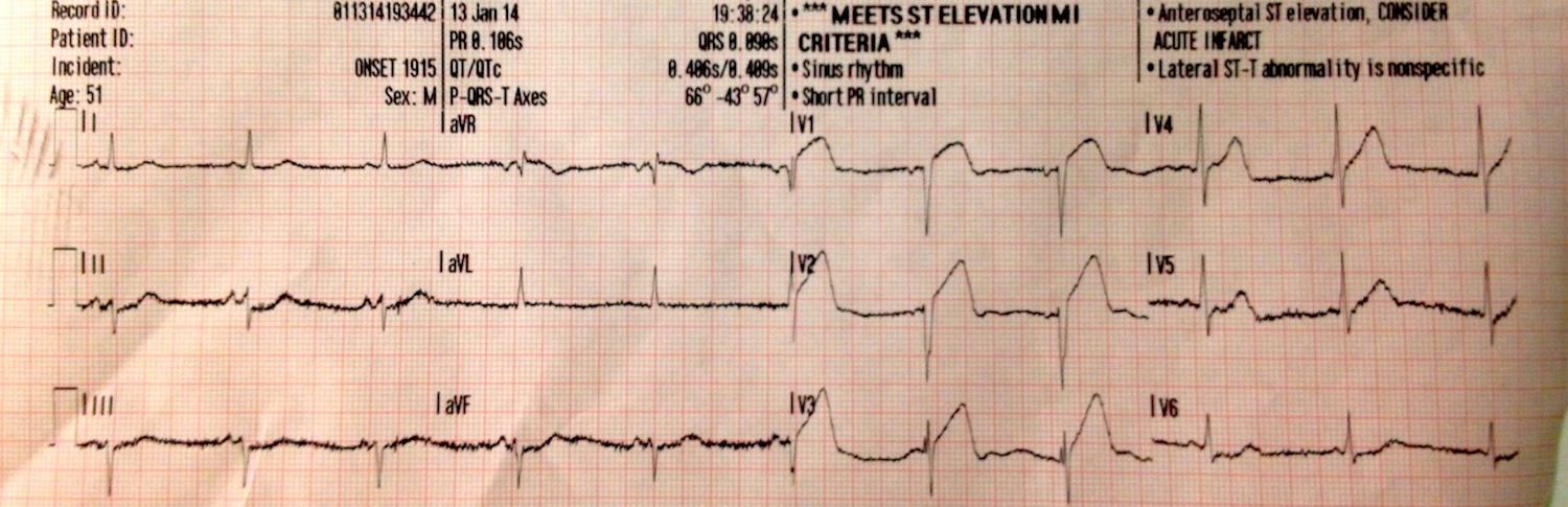 Wellens Sendromu 10 Kaynak : lifeinthefastlane.com - ECG library