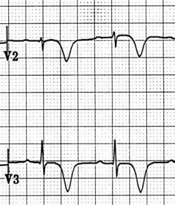 Wellens Sendromu 4 Kaynak : lifeinthefastlane.com - ECG library