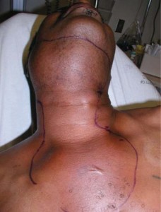 Severe_Ludwig_s_Angina_extending_into_chest-560x735