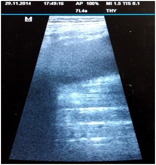 Ultrasonda Plevral efüzyonun altında görülen konsolide akciğer parankimi.