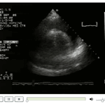 Temel Ultrasonografi – Kardiyak Ultrasonografi 14 Ciddi perikardiyal efüzyon ve sağ ventrikül diastolik kollaps sonoguide.com