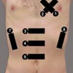 Temel Ultrasonografi – Kardiyak Ultrasonografi 16 Hipotansif hasta protokolü. 1-3 kardiyak, 4-5 aorta, 6-8 Fast