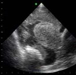 Temel Ultrasonografi - EFAST 17 Uterus etrafında yaygın sıvı