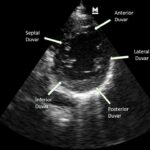 Temel Ultrasonografi – Kardiyak Ultrasonografi 18 Parasternal kısa aks, sol ventrikül duvar segmentleri