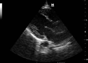 Temel Ultrasonografi – Kardiyak Ultrasonografi 3 Video: Parasternal uzun aks