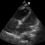 Temel Ultrasonografi – Kardiyak Ultrasonografi 19 Ritm görülen ama nabız alınamayan hasta