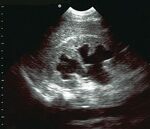 Temel Ultrasonografi - Renal 11 Orta hidronefroz, longitudinal görüntü