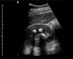 Temel Ultrasonografi - Renal 12 Renal taş ve akustik gölgesi