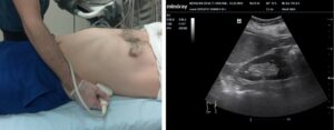 Temel Ultrasonografi - Renal 7 Normal sol renal görüntüleme, supin veya sağ lateral dekübit pozisyonda bakılır