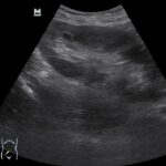 Temel Ultrasonografi - Renal 14 Transplante böbrek, pelvilk bölgede hemen cilt altında görüntülenmekte