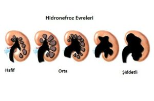 Temel Ultrasonografi - Renal 9 Renal Hidronefroz