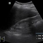 Temel Ultrasonografi - Renal 15 "Kronik renal yetmezlik" böbreği. Küçük ve hiperoekoik (KC ile karşılaştırın)