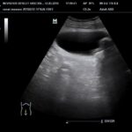 Temel Ultrasonografi - Renal 16 Mesanede sonda, longitudinal görüntü