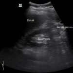 Temel Ultrasonografi - Renal 8 Normal sol renal transvers görüntü
