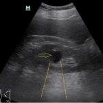 Temel Ultrasonografi - Renal 13 Renal kist ve akustik güçlenme