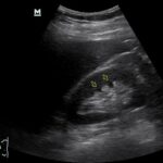 Temel Ultrasonografi - Renal 5 Video: Normal sağ böbrek longitudinal görüntü