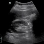 Temel Ultrasonografi - Renal 6 Video: Normal sağ böbrek transvers görüntüsü