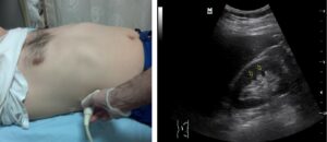 Temel Ultrasonografi - Renal 3 Normal sağ böbrek longitudinal görüntüleme. Sarı ok: pramidler