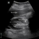 Temel Ultrasonografi - Renal 4 Normal sağ böbrek transvers görüntüsü