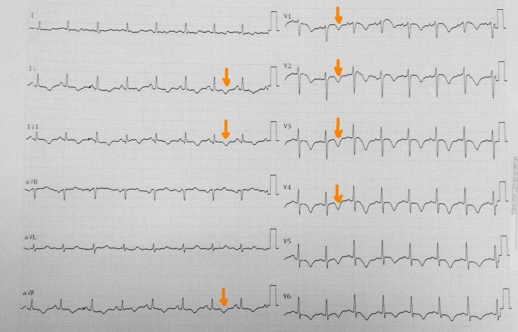 emboli ekg (1)