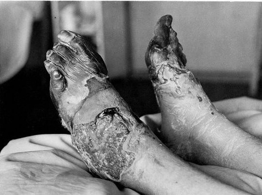 Birinci Dünya Savaşı sırasında, siper ayağı vakası