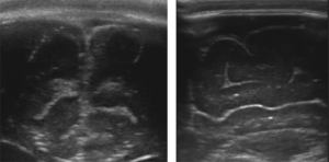Şekil 1: Normal kontrol hastalarında lineer prob kullanılarak alınmış Transvers (sol) ve sagittal (sağ) kraniyal ultrason görüntüleri.