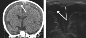 Şekil 2: 2 aylık hastada kronik (kalın ok) üzerine akut (ince ok) subdural hematomları gösteren koronal BT ve ona karşılık gelen kraniyal USG görüntüsü.
