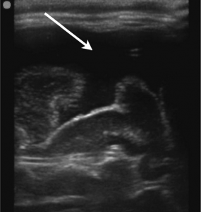Şekil 3: 10 aylık hastada yüksek frekanslı prob ile alınmış SDH’yi (ok) gösteren sagittal kraniyal USG görüntüsü