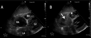 Solda salin puşesi öncesi normal ekokardiyografi görüntüsü. Sağda büyük ok sağ atriyum içindeki salin türbülansını, küçük ok ise sağ ventriküle geçen türbülansı gösteriyor.