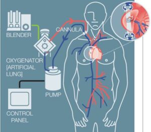 What is ECMO? DOI: 10.1164/rccm.1936P9'dan alıntıdır