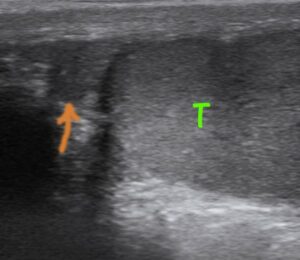 Ok, epididimal baş; T, testis