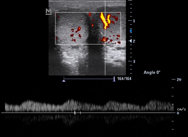 Spectral doppler, arteriyal akım
