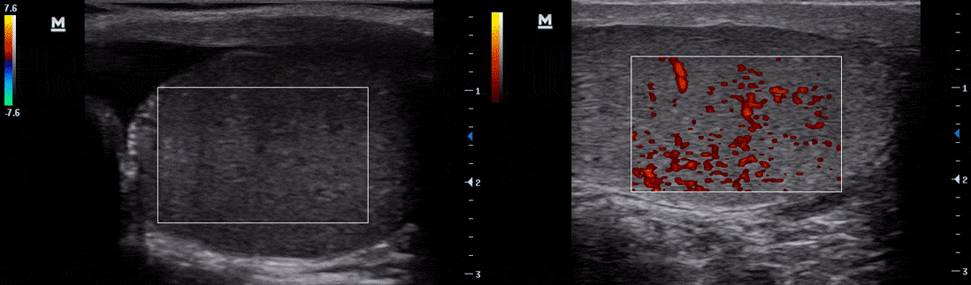 Testis-doppler, Solda (torsiyone); hipoekoik, boyutu artmış testis ve hidrosel görünümü.