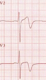 Wellens-2