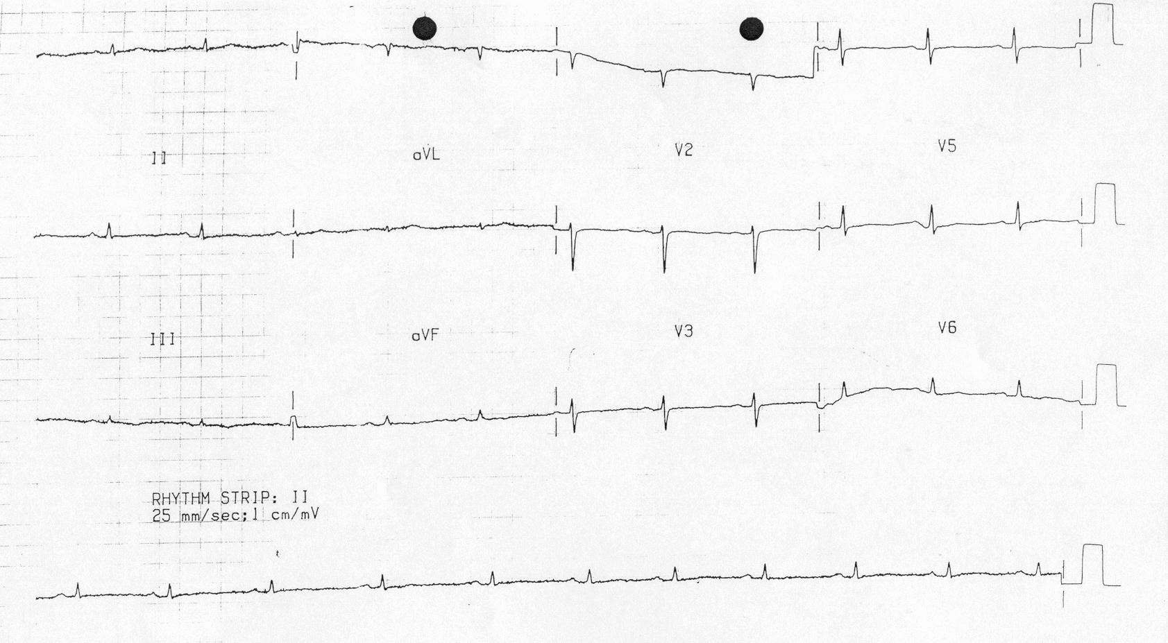Kaynak : lifeinthefastlane.com - ECG library