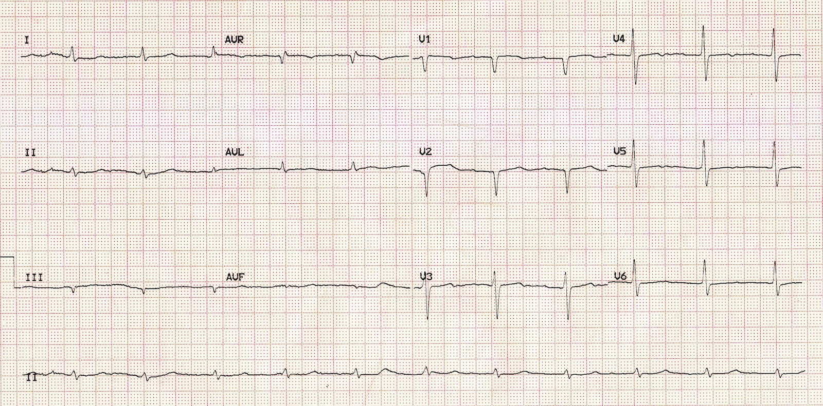 Kaynak : lifeinthefastlane.com - ECG library