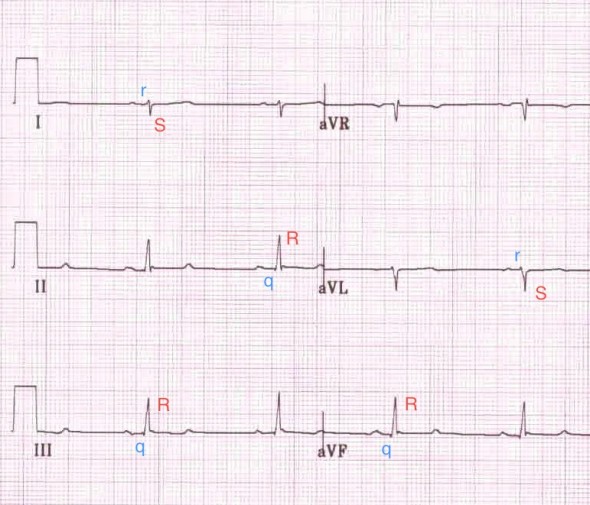 I ve aVL derivasyonlarında rS kompleksleri, II, III ve aVF'de qR kompleksleri. Kaynak : lifeinthefastlane.com - ECG library