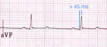 aVF'de > 45 ms uzamış R dalga tepe süresi (= QRS başlangıcından R dalga pikine kadar geçen süre). Kaynak : lifeinthefastlane.com - ECG library