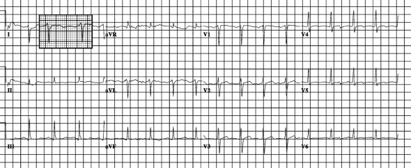 Sol posterior fasiküler blok Kaynak : lifeinthefastlane.com - ECG library