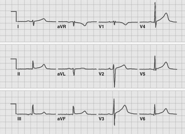 Sol posterior fasiküler blok. Kaynak : lifeinthefastlane.com - ECG library