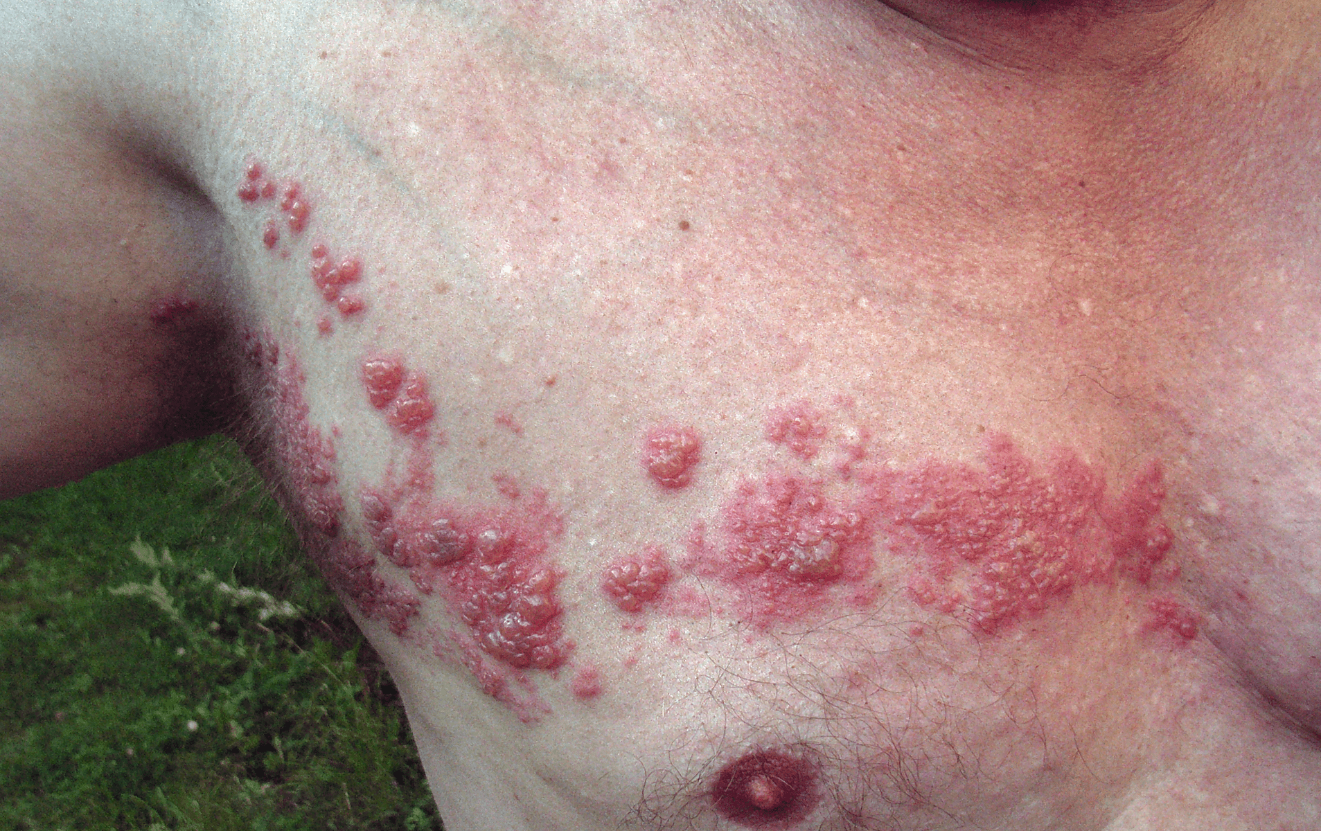 Ülker: Herpes Zoster, Kanıta Dayalı Tedavi Yöntemleri 1 Ülker: Herpes Zoster, Kanıta Dayalı Tedavi Yöntemleri 1