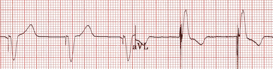 Ventriküler paceli ritim ile birlikte uygun diskordans Kaynak : lifeinthefastlane.com - ECG library