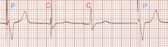 P=paceli vuru C = yakalama vurusu Kaynak : lifeinthefastlane.com - ECG library